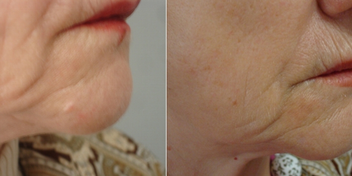 Radiofrequency tangential excision - after 6 months